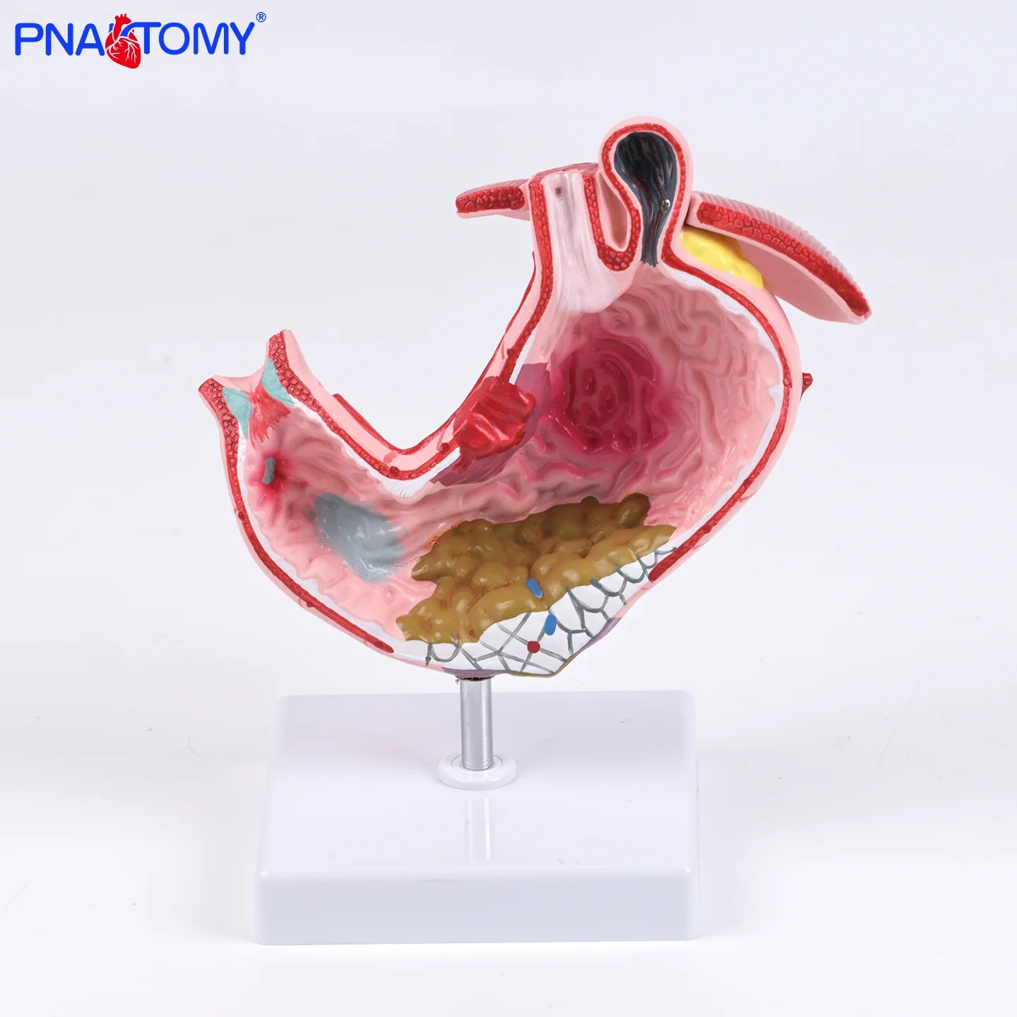 Pathological Stomach Anatomy Model