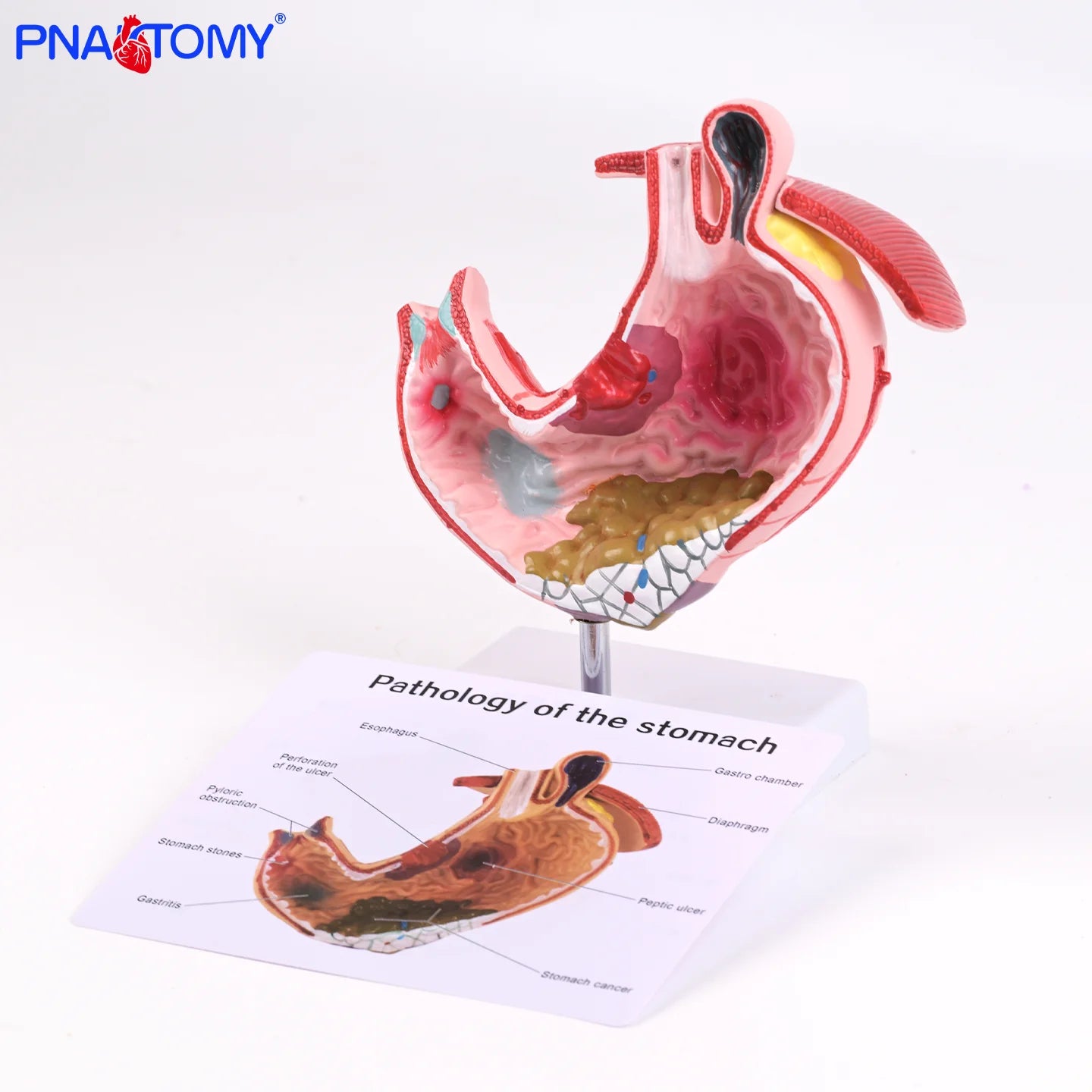 Pathological Stomach Anatomy Model